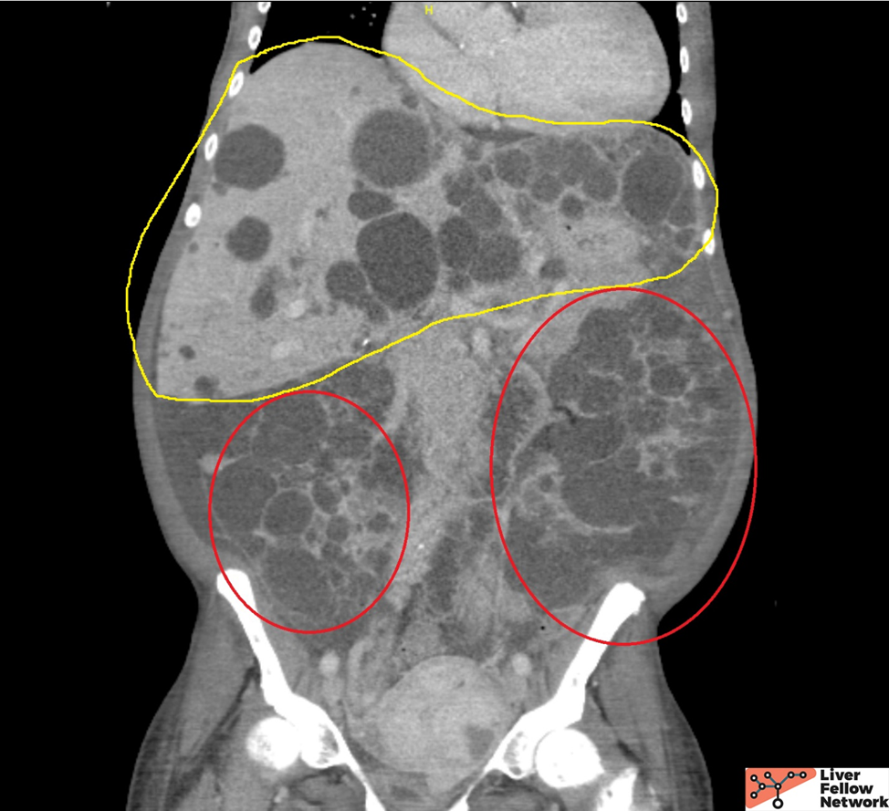 Pathology Pearls Autosomal Dominant Polycystic Kidney Disease