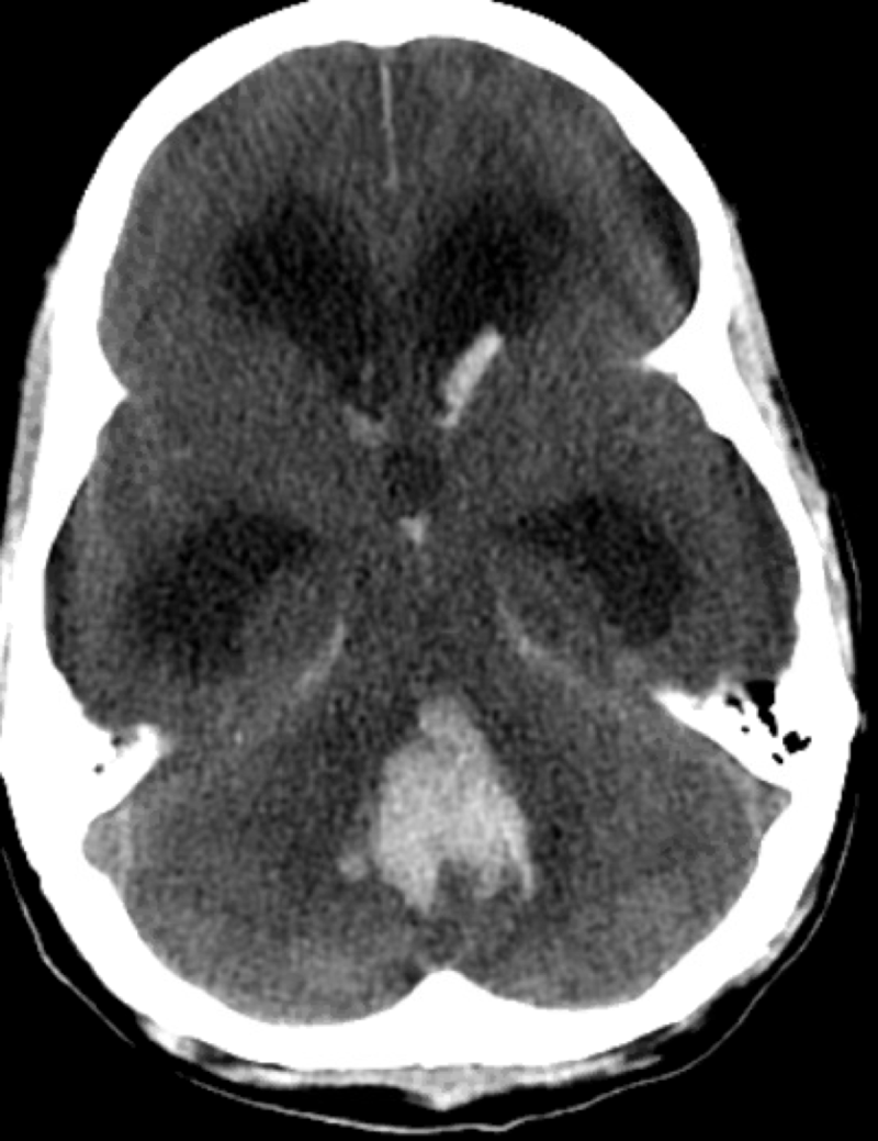 Intracranial hemorrhage, with blood present in the in the fourth ventricle and posterior fossa.