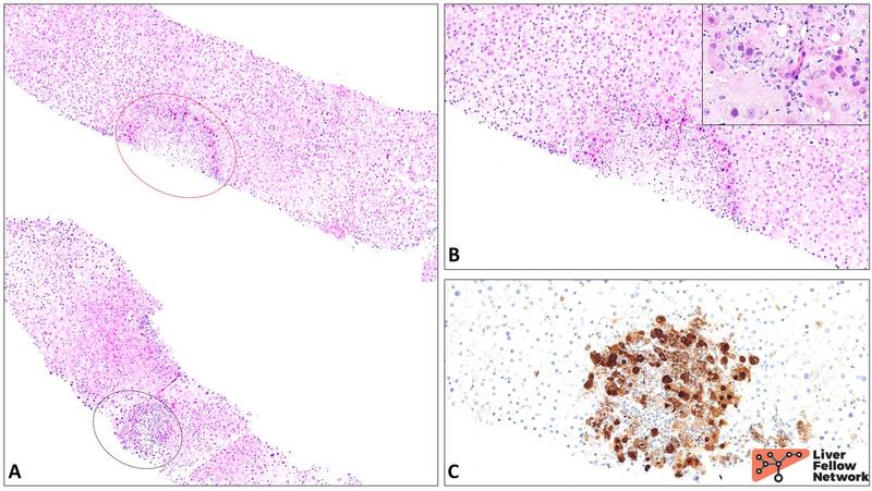 presentation of acute viral hepatitis