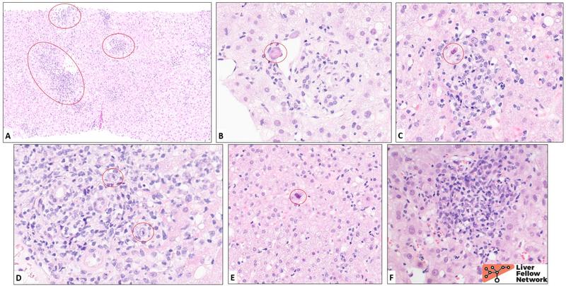 presentation of acute viral hepatitis