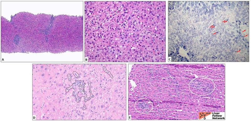 presentation of acute viral hepatitis