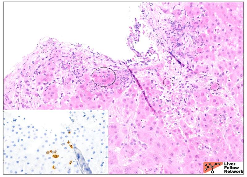 presentation of acute viral hepatitis