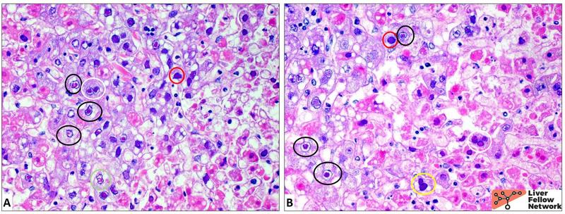 presentation of acute viral hepatitis