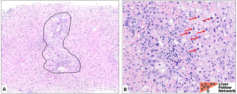 presentation of acute viral hepatitis