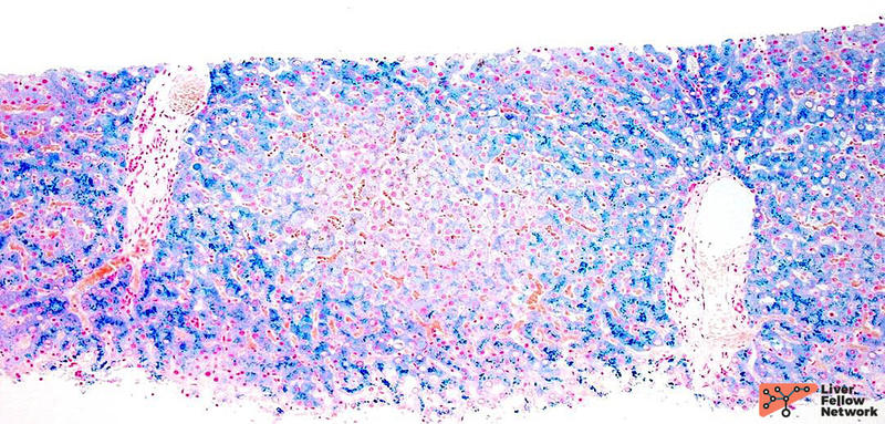 Perls Staining Liver Biopsy Interpretation: Special Stains | AASLD