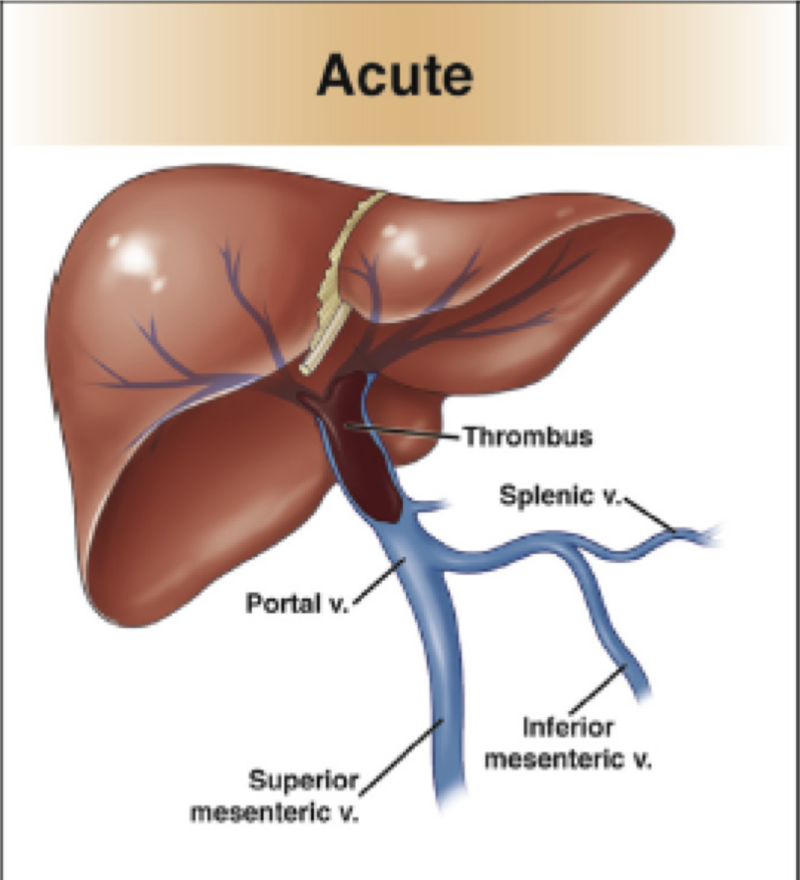 quelling-the-swelling-aasld