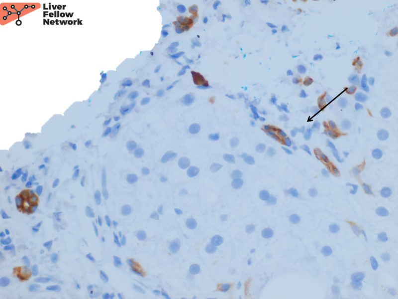Pathology Pearls Wilson Disease AASLD