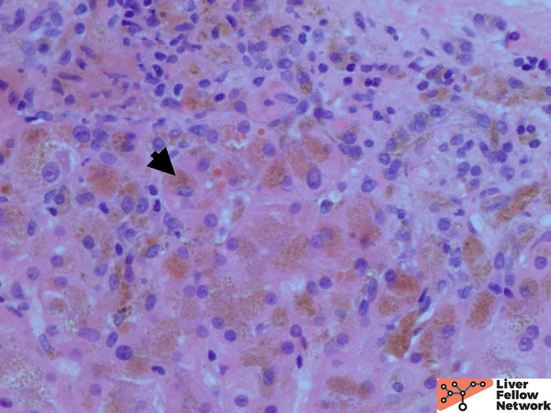 PATHOLOGY PEARLS: HEREDITARY HEMOCHROMATOSIS | AASLD