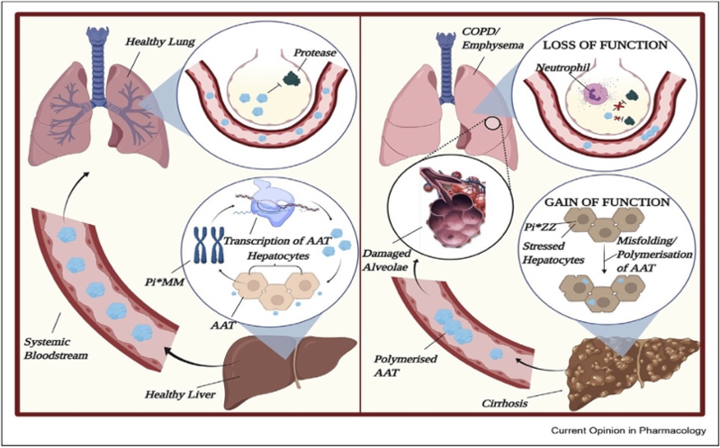 Why does alpha-1 antitrypsin deficiency cause liver disease? | AASLD