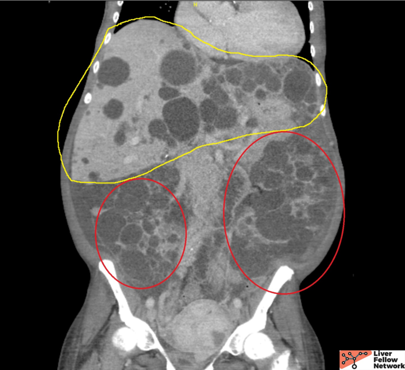 pathology-pearls-autosomal-dominant-polycystic-kidney-disease